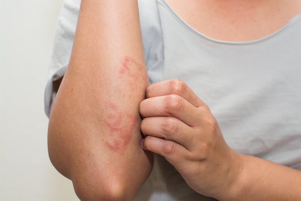 A close-up of a person's bent arm with eczema marks, with their hand touching the arm